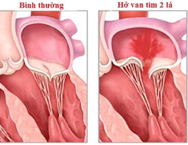 Hở van tim 2 lá 1/4 là gì?