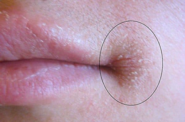 Hình ảnh nấm miệng được thể hiện qua khóe miệng khô, nứt nẻ