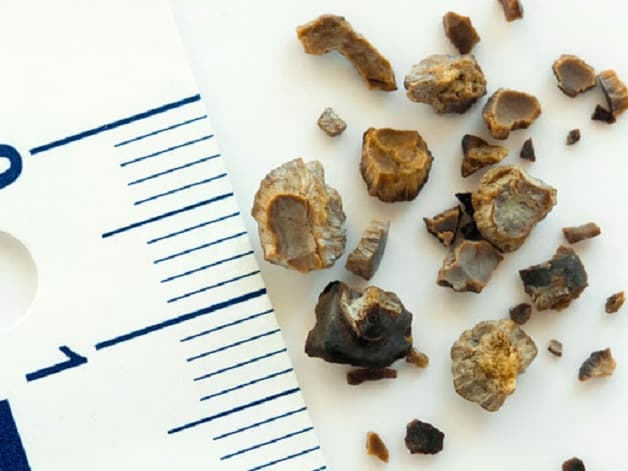 Mổ sỏi tiết niệu áp dụng cho các trường hợp sỏi phức tạp, có kích thước lớn.