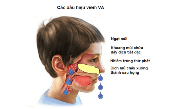 Viêm VA là bệnh lý dễ gặp ở trẻ nhỏ