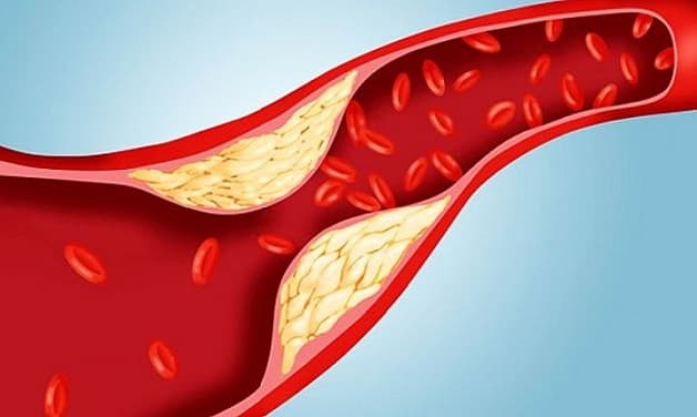 Xơ vỡ động mạch là một trong những nguyên nhân gây các bệnh van tim