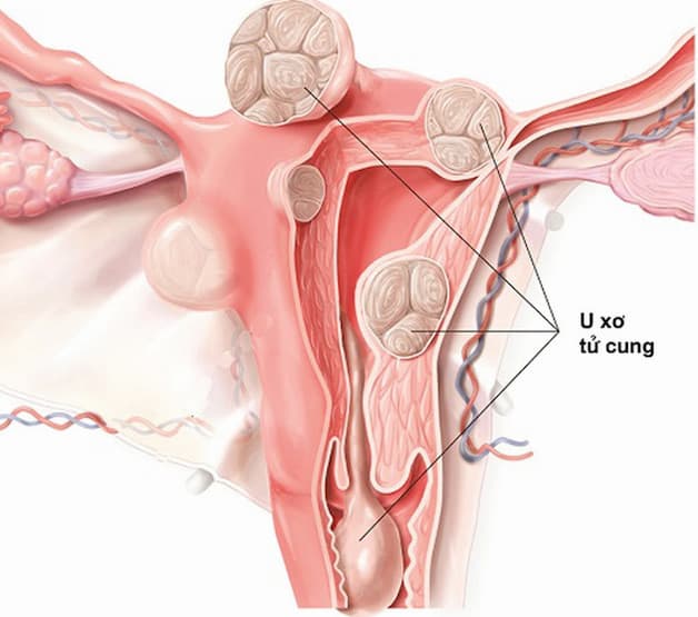 U xơ tử cung 