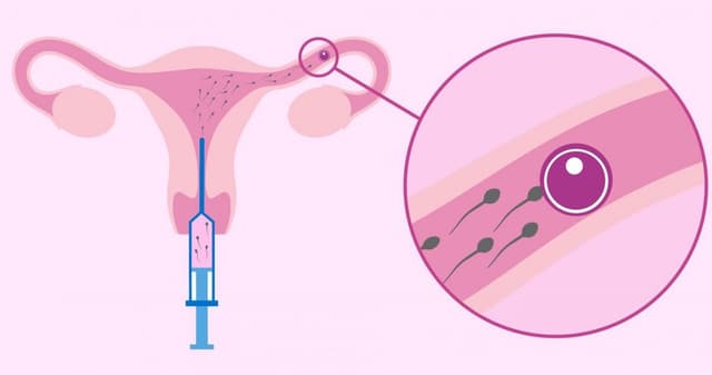 IUI là phương pháp gì và quá trình làm IUI như thế nào?