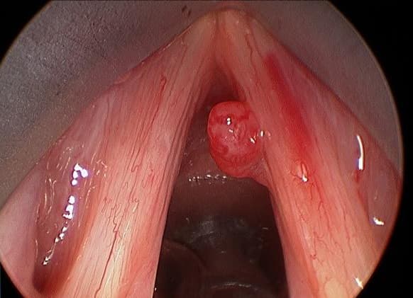 Polyp thanh quản là gì? - Hình ảnh một polyp thanh quản thông qua ảnh chụp nội soi