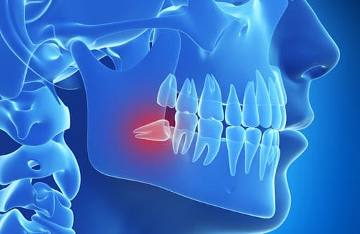 nhổ răng khôn sau bao lâu thì lành