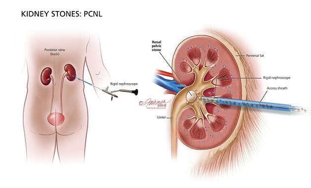 Các phương pháp tán sỏi ít xâm lấn đang dần thay thế phương pháp mổ hở