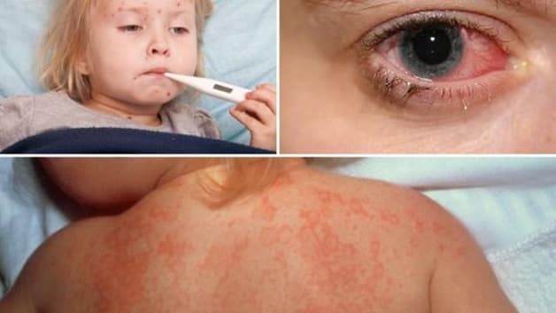 Triệu chứng sốt siêu vi ở trẻ hay gặp là: sốt, ho, phát ban trên da, đỏ mắt,...