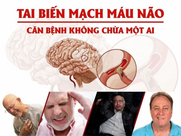 Tai biến hay đột quỵ não là căn bệnh không chừa một ai