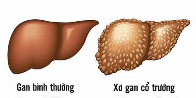 thế nào là xơ gan mất bù