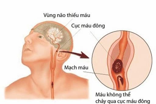thiếu máu não thoáng qua có thể gây tổn thương các tế bào não