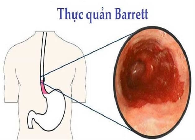 biến chứng trào ngược dạ dày thực quản