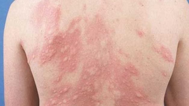 triệu chứng của xơ gan giai đoạn 2