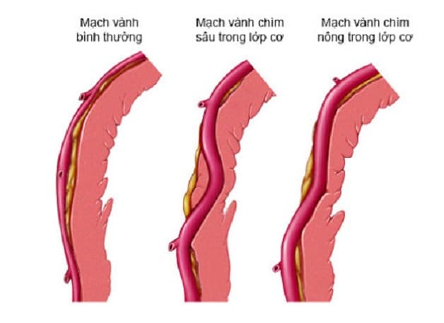 Hình ảnh cầu cơ động mạch vành