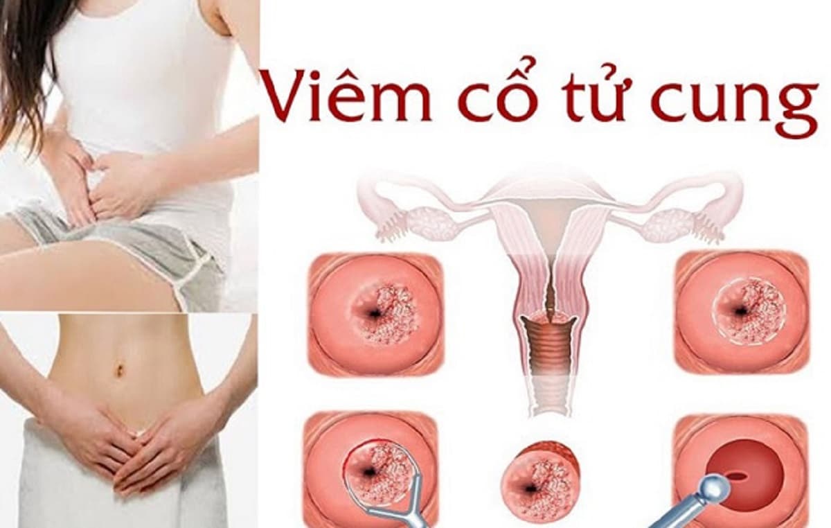 Mách mẹ cách điều trị hiệu quả viêm cổ tử cung sau sinh 
