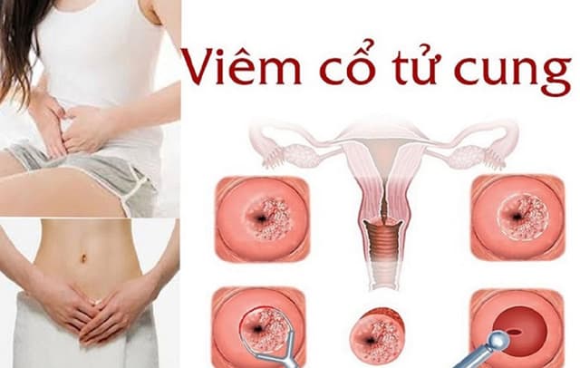 Mách mẹ cách điều trị hiệu quả viêm cổ tử cung sau sinh 