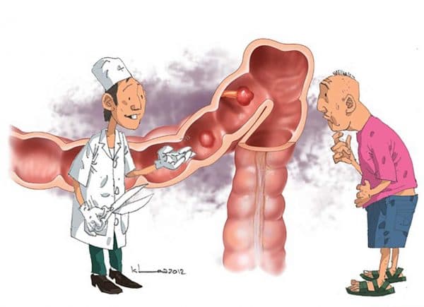 Điều trị viêm đại trực tràng