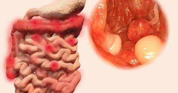 Hình ảnh viêm loét đại trực tràng chảy máu