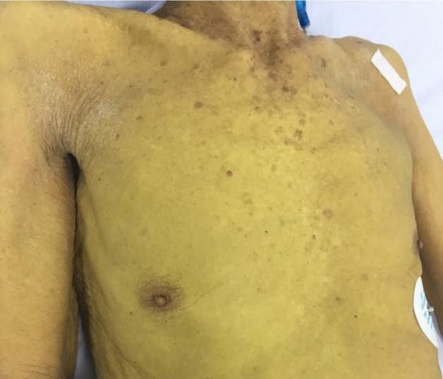 xơ gan ứ mật có triệu chứng như thế nào