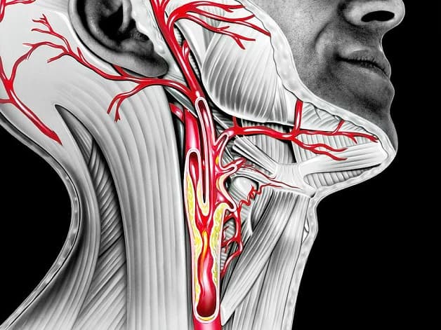 Xơ vữa động mạch cảnh là hiện tượng hình thành các mảng xơ vữa ở động mạch đưa máu từ tim lên nuôi não.
