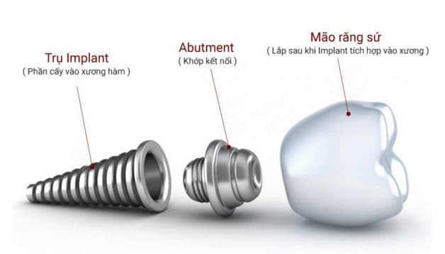Abutment có vai trò vô cùng quan trọng trọng việc kết nối trụ implant với mão sứ răng