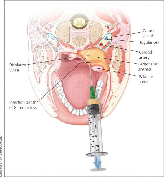 Điều trị áp xe quanh amidan