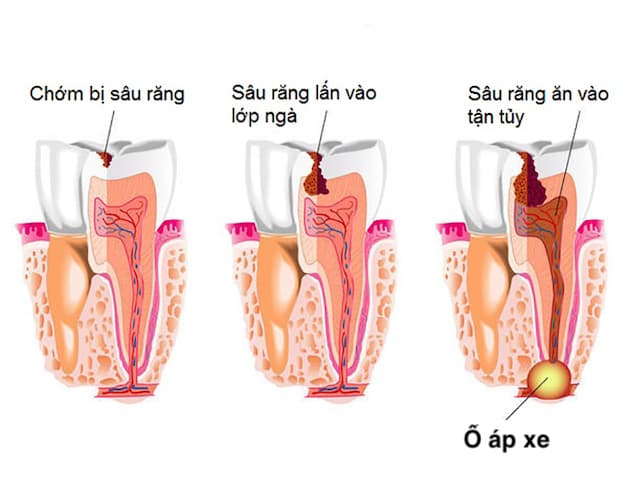 Sâu răng, viêm tủy răng là nguyên nhân hàng đầu gây áp xe răng.