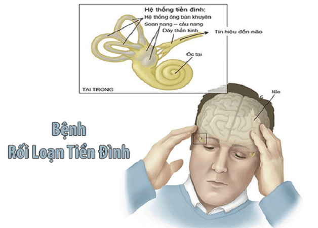 Tìm hiểu về bệnh lý rối loạn tiền đình. Hệ thống tiền đình gồm gì?