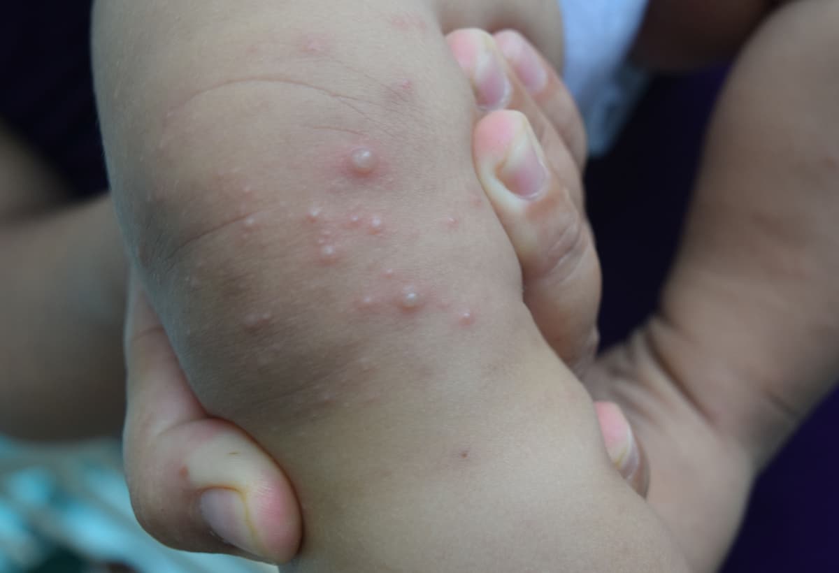 Trẻ bị tay chân miệng có mụn ẩn và mụn hiện rõ trên da