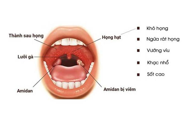 Viêm họng hạt có thể gặp ở mọi lứa tuổi