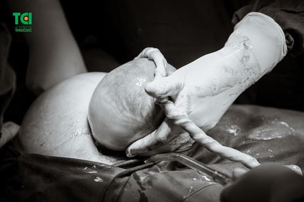 Đẻ bọc điều là tình trạng em bé sinh ra vẫn còn nằm nguyên trong túi ối và chỉ chiếm 1/80.000 ca sinh