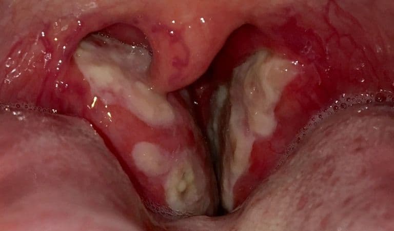 Hình ảnh amidan bị viêm và mất chức năng