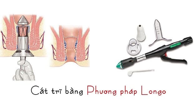Cắt trĩ bằng phương pháp Lông là kỹ thuật hiện đại, hạn chế tái phát, giảm đau đớn cho người bệnh và vết thương nhanh lành