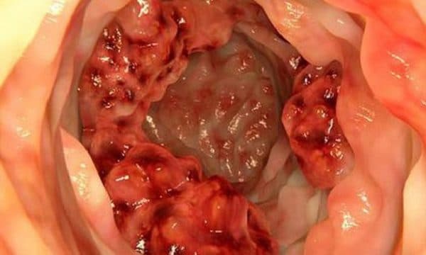 Polyp đại trực tràng là những tổn thương ở vùng niêm mạc của trực tràng