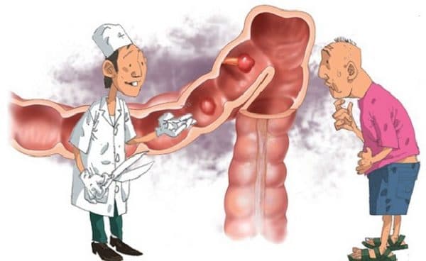 Đa polyp đại trực tràng không có biểu hiện điển hình