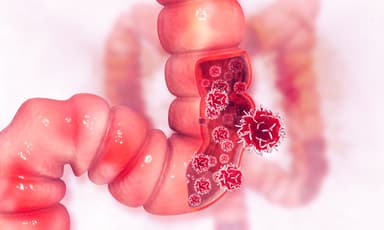 Ung thư đại trực tràng: Cách phòng tránh và phát hiện sớm