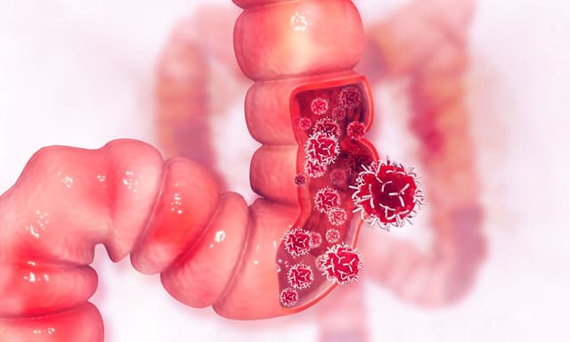 Ung thư đại trực tràng: Cách phòng tránh và phát hiện sớm
