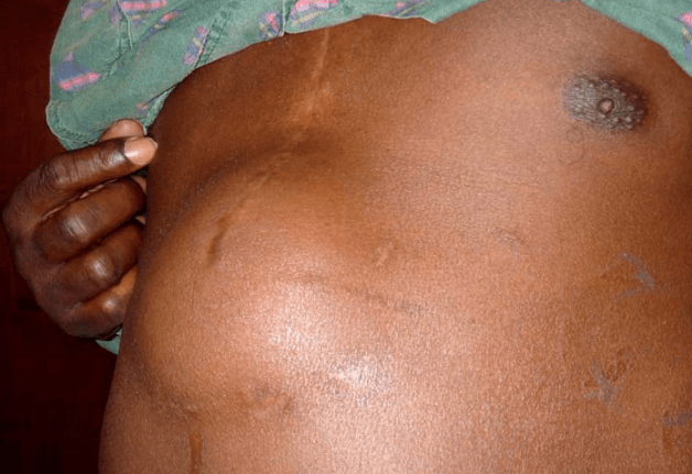 triệu chứng cần điều trị thoát vị