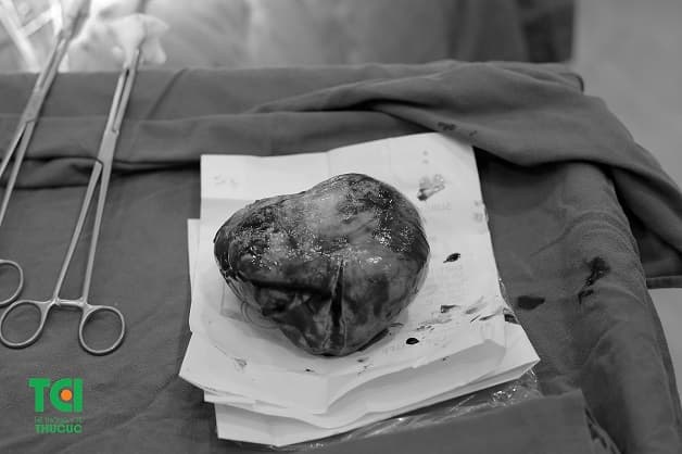 Khối u nang buồng trứng kích thước “khủng” của chị H.