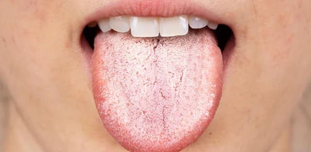 Nấm miệng Candida là bệnh gì?