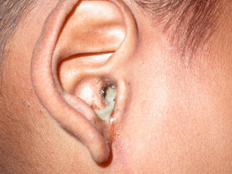 Nấm tai không điều trị kịp thời sẽ có thể dẫn đến viêm tai giữa và chảy mủ