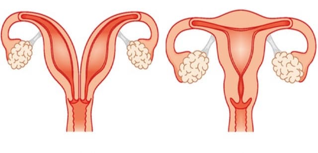 Nguyên nhân bị tử cung đôi và cách điều trị an toàn