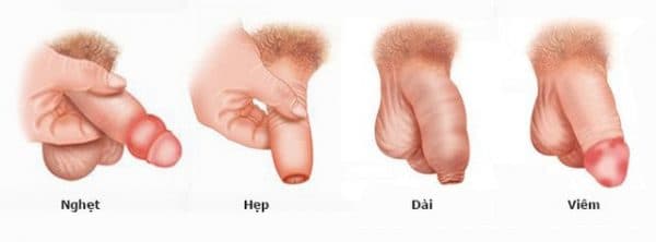 Phẫu thuật cắt bao quy đầu cho trẻ em