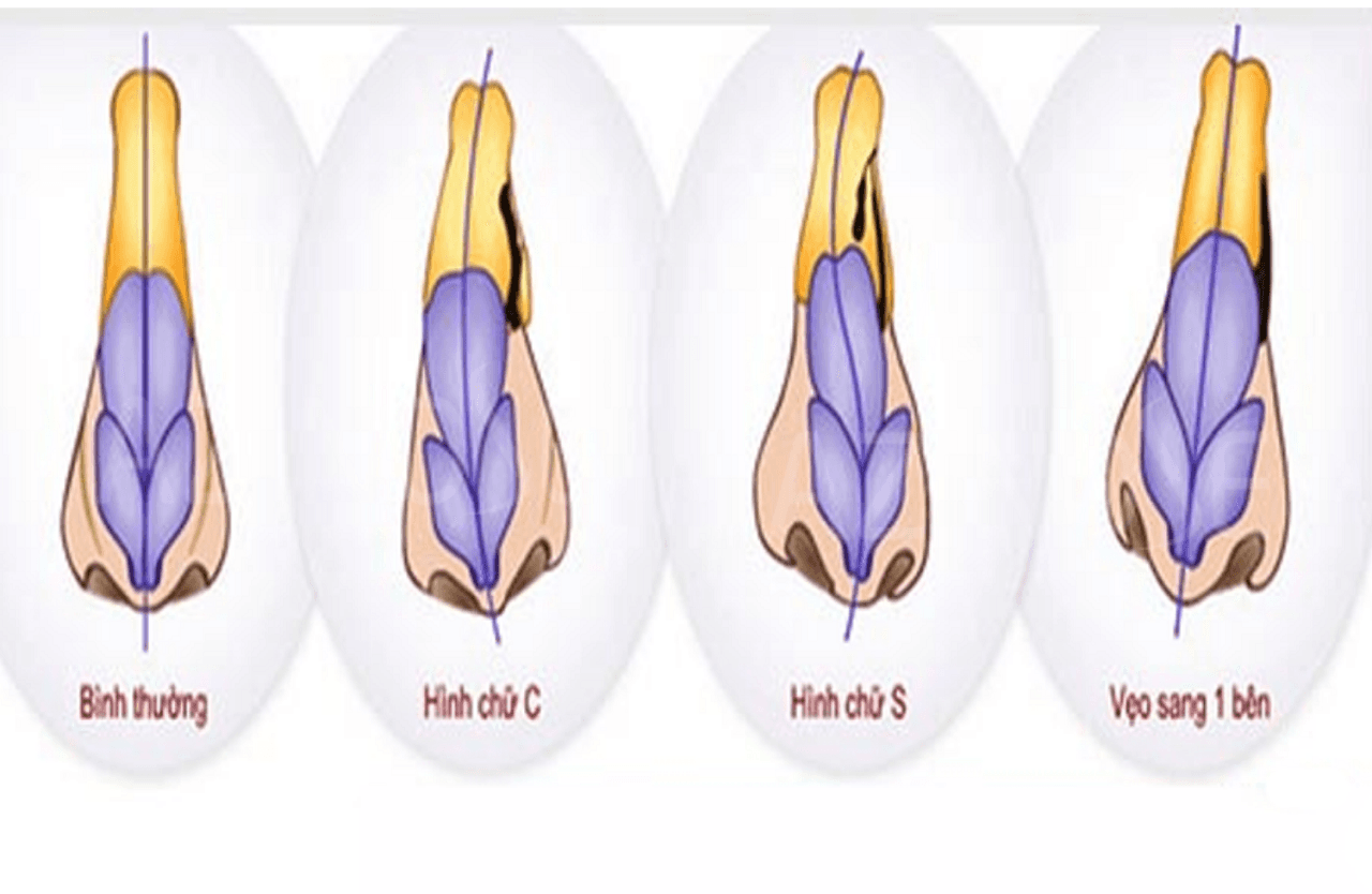 Mũi bình thường và mũi bị lệch vách ngăn