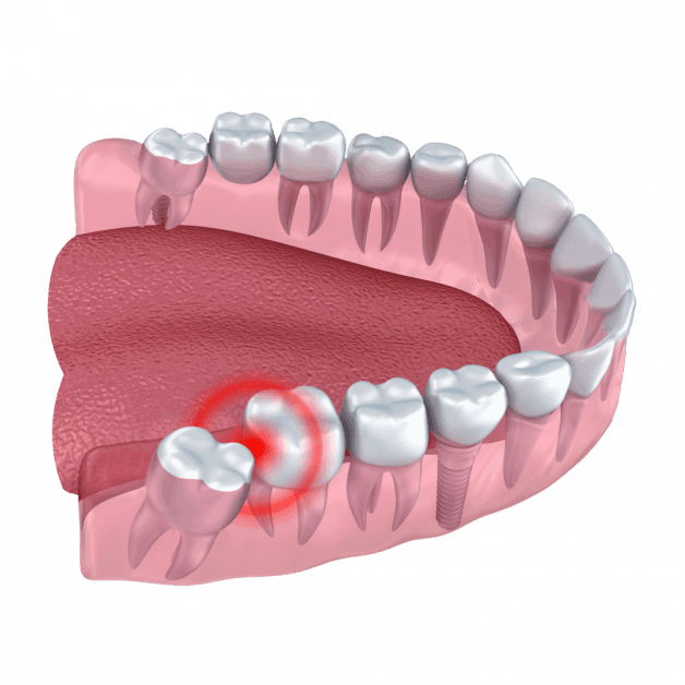 nhổ răng khôn nguy hiểm không