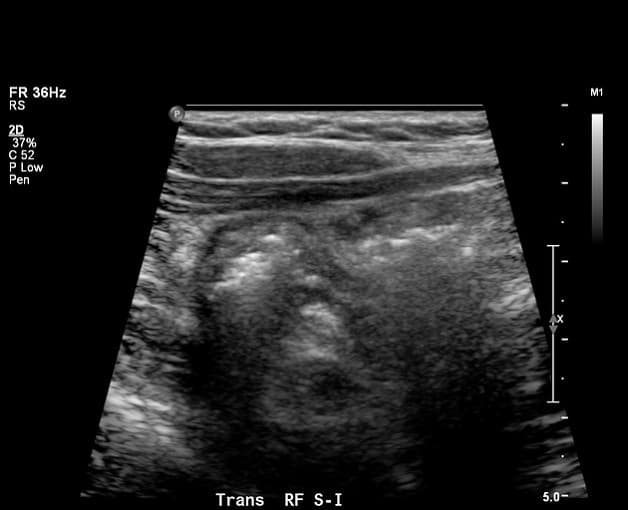 Các chuyên gia chăm sóc sức khỏe sử dụng siêu âm làm xét nghiệm hình ảnh đầu tiên cho khả năng viêm ruột thừa ở trẻ sơ sinh, trẻ em, thanh niên và phụ nữ mang thai.