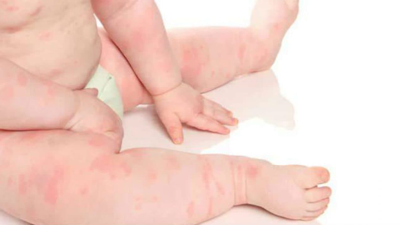 Phát ban do virus Rubella