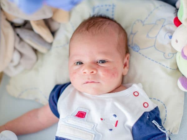 Triệu chứng sốt virus