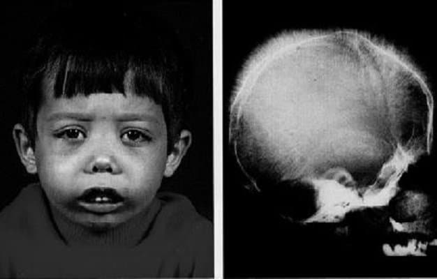 Thiếu máu di truyền ở trẻ em gây ra những biến đổi trên gương mặt khi trẻ lớn lên