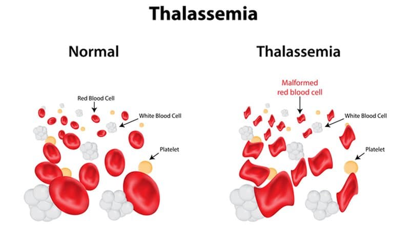 Thiếu máu di truyền huyết tán còn được biết đến với tên gọi bệnh Thalassemia