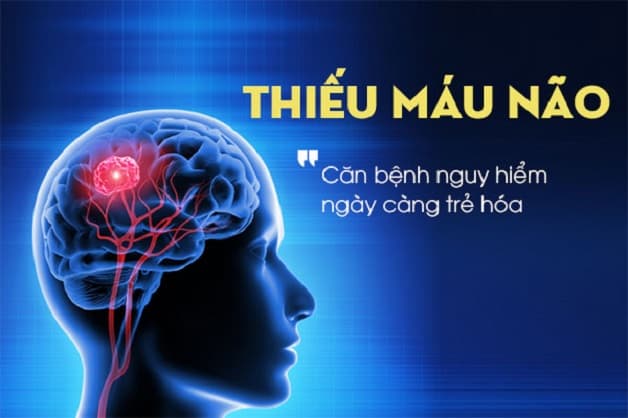 Thiếu máu não là gì?